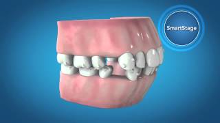 Invisalign G6 Innovations for First Premolar Extraction [upl. by Ajna]