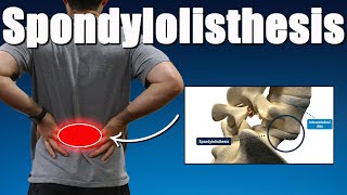 Lumbar Spondylolisthesis Best Exercises Rehab Advice amp Myth Busting for Back Pain Relief [upl. by Schweitzer]