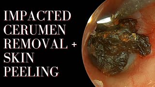 Impacted Cerumen Removal  Skin Peeling [upl. by Grory225]