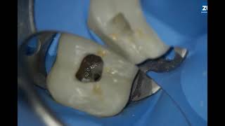 36 Root Canal Treatment Through Crown CALCIFIED CANALS [upl. by Bina]