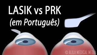 LASIK ou PRK O que é mais adequado para mim Alila Medical Media Português [upl. by Baumbaugh]