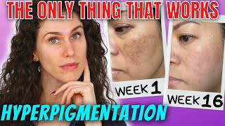 The ONLY Ingredients That Stop Hyperpigmentation And Reverse It [upl. by Ydde]