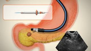 Radiofrecuencia en tumor de páncreas  EUSRA con endosonógrafo [upl. by Standush]