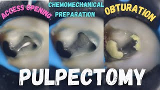 Pulpectomy  access opening  chemomechanical preparation  obturation  pulpectomy procedure 84 [upl. by Nodnyl]