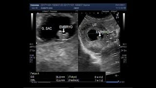 Ultrasound Video showing a case of missed miscarriage of about 7 to 8 weeks [upl. by Dorin]