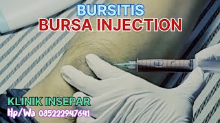 BURSITIS  BURSA INJECTION  ruralhealthcare syarhan [upl. by Aicital]