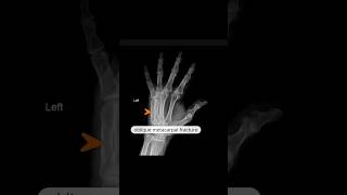 lucent oblique fracture line in the fifth metacarpal xray hand reels [upl. by Iolenta]