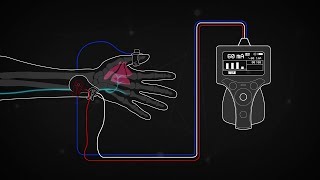 Train of Four Monitoring using the Ulnar Nerve [upl. by Eden]