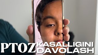 PTOZ KASALLIGINI DAVOLASH [upl. by Goltz]