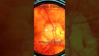 Myopic Fundus  Fundus Photography  Myopic Crescent  Short Video 142 viral optometryacademy [upl. by Bree]