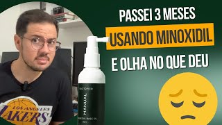 3 meses usando minoxidil e finasterida da Manual e esse é o resultado VÍDEO 3 [upl. by Bergen]