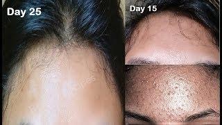 How to clear Tiny bumps on forehead small pimples small bumps on face Acne Prone Skincare Routine [upl. by Terhune]