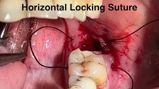 Horizontal locking suture post extraction l 7044611705 l DrArindam Mandaloralsurgery [upl. by Ennaeed]