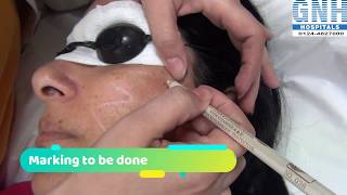 Treatment of Melasma amp Hyperpigmentation at GNH Hospital Gurgaon [upl. by Taran]