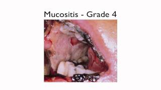 What is Mucositis [upl. by Namolos36]