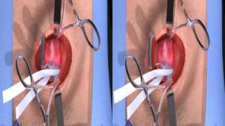 Open Hernia Procedure  3D Stereographic Animation [upl. by Pansie]