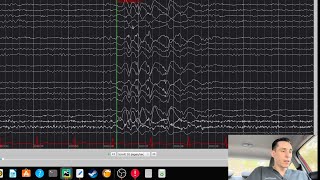 EEG with Frontal Spike amp Wave Discharges [upl. by Naired712]