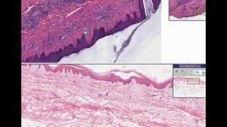 Histopathology SkinLymphocytic infiltrate possible tick b [upl. by Trip]