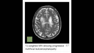 Progressive Multifocal Leukoencephalopathy PML [upl. by Cooper449]