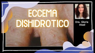 ¿Qué son las bombitas de agua que salen en la piel ECCEMA DISHIDRÓTICO 💧💦 DISHIDROSIS [upl. by Herc]