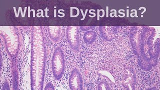 What is Dysplasia  Pathology mini tutorial [upl. by Clywd]