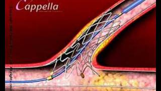 Cardiology heart valve stent3D medical animation produced by Virtual Point [upl. by Henson]