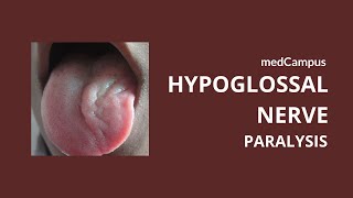 Tongue deviation in hypoglossal nerve palsy  Neuroanatomy  Cranial Nerves  medCampus [upl. by Hamilton]