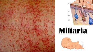 Miliaria Heat rash [upl. by Aelanna]