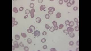 HEMEFLIX Hypochromia and Howell Jolly Bodies [upl. by Banyaz]