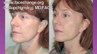 Mid Facelift Procedure Video [upl. by Devora]