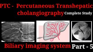 Percutaneous Transhepatic Cholangiography  PTC  Procedure  Biliary imaging system part  5 [upl. by Aipotu]