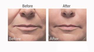 Botox vs Dermal Fillers [upl. by Hapte]