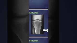 Bone tumors Giant cell tumor [upl. by Marianne]