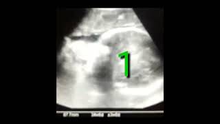 BOTH FEMALES GENDER AND CEPHALIC l TWIN PREGNANCY l 🔥🔥🔥 1 baby doctor ultrasound pregnancy [upl. by Riem]