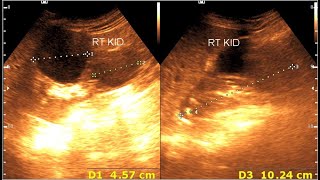 Renal cortical cyst  Milk of calcium cyst  Renal calcification [upl. by Rivalee]