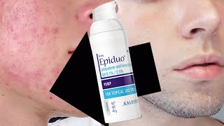 COMO CURE MI ACNE CON PEROXIDO DE BENZOLIO Y ADAPALENO Epiduo 100 EFECTIVO [upl. by Ylrebmi]