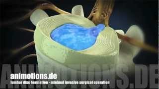 Herniation quotlumbarquot Treatment Surgery 3D Animation [upl. by Hermie]