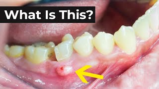 What is an Abscessed Tooth amp What To Do About It [upl. by Bohon]