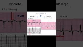 Cómo Identificar Tipos de Taquicardia en el Electrocardiograma  Dr Jose Porto [upl. by Asiret]