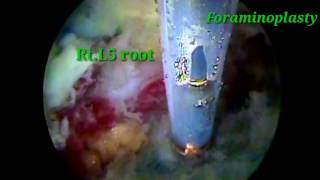 Percutaneous endoscopic Foraminoplasty and disc removal on L5S1 with high iliac crest [upl. by Neersan]