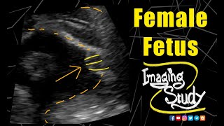 Female Fetus  28th Week  Breech Presentation  Ultrasound  Case 165 [upl. by Nosnevets]