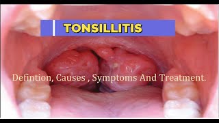 What Is Tonsillitis Its Causes symptoms amp treatment  Why Do Tonsils Get Infected  Medico Star [upl. by Flemings]