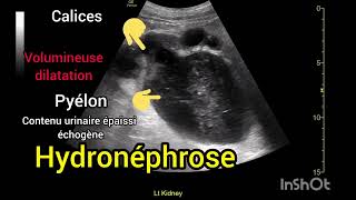 Hydronéphrose Dilatation pyélocalicielle majeure rein gauche Échographie [upl. by Adelaide]