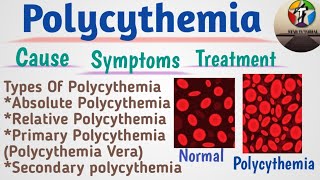 Polycythemia In Hindi ll Polycythemia Vera ll Hematology And Blood Banking [upl. by Lirpa]