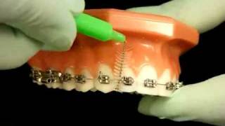 Bracesquestionscom  Brushing With Braces How to Brush Teeth [upl. by Susi265]