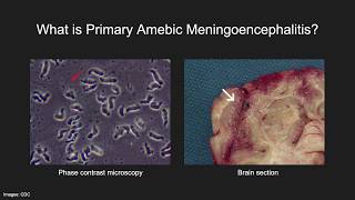 Primary Amebic Meningoencephalitis [upl. by Nevins]