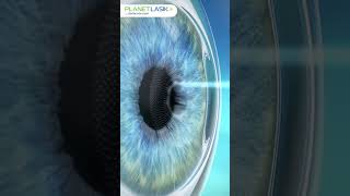 A Comprehensive Guide on Advanced SpecsRemoval Eye Surgeries SMILE Contoura Vision and ICL [upl. by Inahpit]