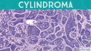 Cylindroma 5Minute Pathology Pearls [upl. by Nomead251]