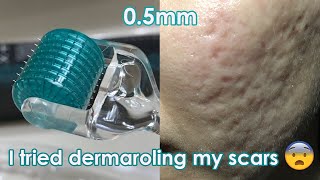 I tried dermarolling my ACNE SCARS  Demo  Review [upl. by Susannah]