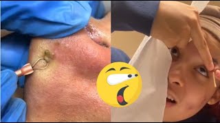 Ultimate Satisfying Blackhead Removal Compilation  Relaxing Skincare Routine [upl. by Hyacinthe]